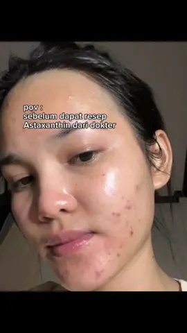 #antaxanthin #acneproneskin 