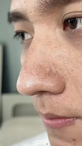 #Anthocyanin bubble mask