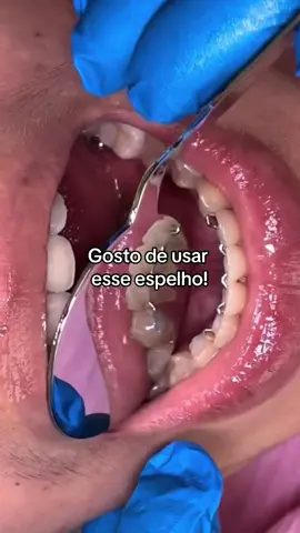 Confere essa limpeza dos dentes que fiz na paciente!!! 🤩 Me conta, você já passou por essa experiência? #odonto #odontologia #teethwhitening #teethcare #dentista #fyyy #fyp 