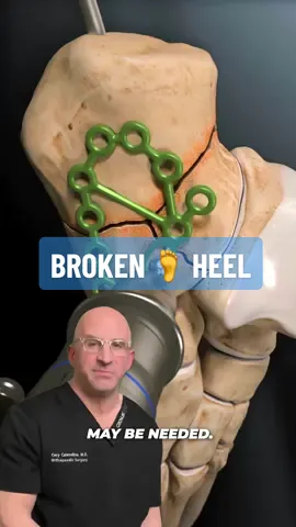 Broken Heel Bone 🦶 Calcaneus fractures are uncommon but potentially debilitating injuries. The #calcaneus bone is one of (7) tarsal bones, part of the hindfoot which includes the calcaneus and talus bone. The hindfoot articulates with the tibia and fibula creating the ankle joint. The subtalar or calcaneotalar joint accounts for at least some foot and ankle dorsal/plantar flexion. Historically a burst fracture of the calcaneus was coined a 