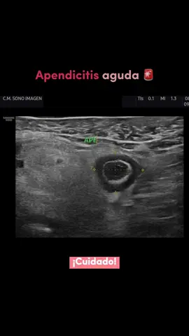 ¿Estás presentando estos síntomas? 😫😫😫 ven a una revisión y recibe el tratamiento oportuno 🤩 #salud #ecografias #bienestar #apendicitis #apendice 