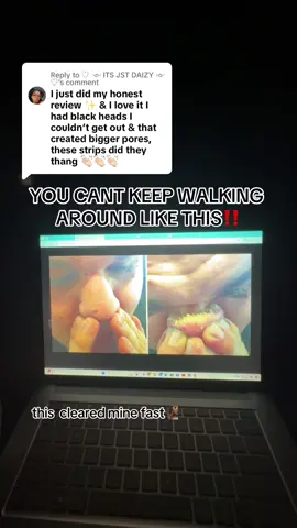 Replying to @♡ ༺ ITS JST DAIZY ༻ ♡ get it before the sale ends. #labenanoseplantsporestrips #skincareproducts #skincaretiktok #skincarehacks 
