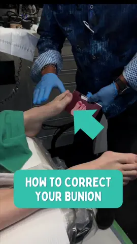 Say goodbye to old methods and embrace the modern bunion correction! The game-changer – MONA LISA Bunion Correction. This innovative approach offers a faster, smoother, and pain-free path to happy, healthy feet. 🌟 Discover how this cutting-edge procedure can transform your experience, ensuring minimal downtime and maximum comfort. #TorontoPodiatrist #MinimallyInvasiveSurgery #explorepage #bunionremoval #bunionremovalsurgery #footsurgery #bunionsurgery #bunioncorrection #buniontiktok