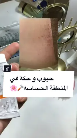 الحل النهائي للحبوب و الحساسية. و الحكة فالمنطقة الحساسة بعد ازالة الشعر✅🪒👍🏻#fyp #foryou #foryoupage #CapCut 