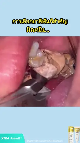 ฟันเหลืองหลายปีก็รักษาได้#canban 21.6.7