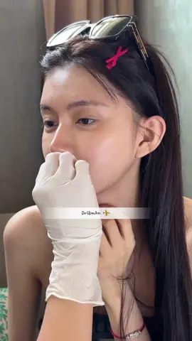 🧑‍⚕️ shortening the philtrum shortens the distance between lips and nose#openeyes #laman #thanksyou #sugeryphiltrum #tiktok2024 