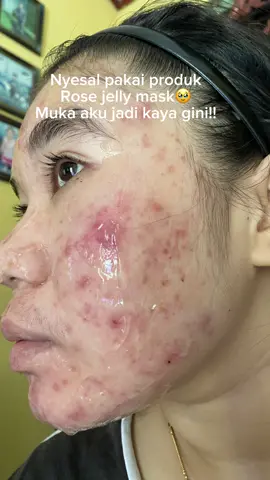 Please kalian jangan coba deh, takut nanti kaya aku juga muka nya😫🥹🫵🏻 #fyp #masukberanda #acneprone #eileengrace #rosejellymask 