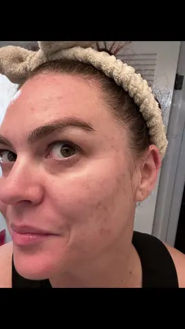 The biggest side effects for me being on a #glp1 one has been the #breakouts. Photos: December 2023 to current. Last month I swapped to #tirzepatide which immediately reduced the active breakouts! now I’m working on the scarring then back to my regularly scheduled program.  #pigmentation #finelinesandwrinkles #progress #sideeffects #glp1forweightloss #acne #acnetreatment 