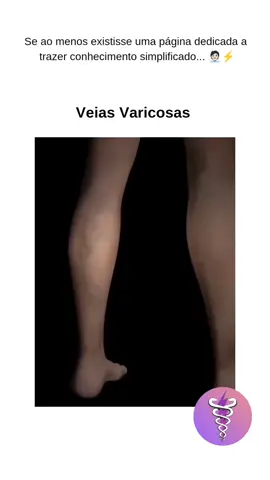 🟣👉🏻 Siga @comofuncionafisio para mais conteúdos como esse As veias varicosas, ou vasinhos, são veias torcidas e dilatadas. São dilatações permanentes das paredes venosas, cujo aparecimento se deve a fatores que provocam a 