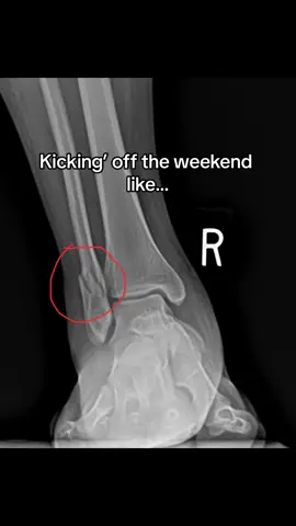 Be careful out there! #brokenankle #trauma #podiatry #footcare #ankles #doctorsoftiktok #podiatristoftiktok #feetofticktock 