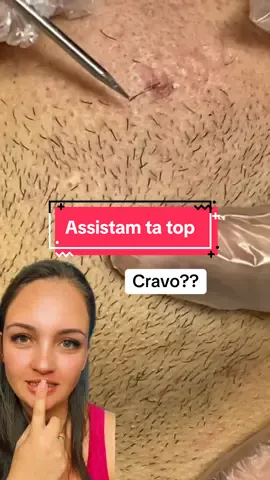 Cravo e cabelo 😱 #cravos #reagindo #limpezasatisfatoria 