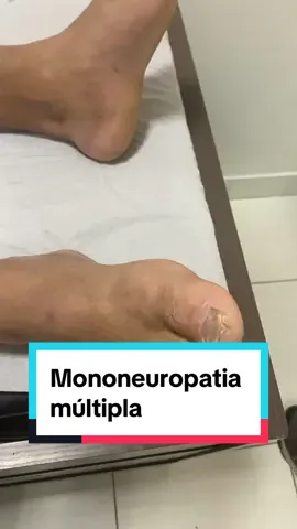 Mononeuropatia Múltipla. #vasculite #mononeuritemultipla #mononeuropatiamultipla #neuropatia #reumatologia #ortopedia #neurologia #neurofisiologia #eletroneuromiografia #eletroneuromiografiaemvaladares #estudiantedemedicina #medicina #fisioterapia #governadorvaladares  @Dr. Yanes Brum  @Dr. Yanes Brum  @Dr. Yanes Brum 