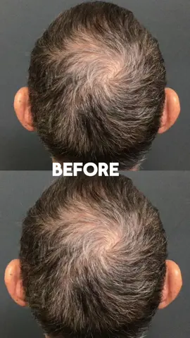 15 years of breakthrough scientific research unlocking the renewing power of platelet-derived exosomes: now available to enhance your hair, skin, & scalp care routine. You can now buy @platedskinscience in our office or for curbside pick up.  To order 📞626.796.3373 . . #hairserum#hairseeums#hairthinningsolution