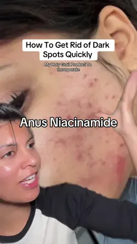 The only one product that actually works for dark spots & acne scars without breakout! And an active that has been the SAFEST for my skin👏🏼    #acnescars #darkspots #hyperpigmentation #acneproneskin #anua #shopfinds #darkspots #acneroutine #anua #creatorsearchinsights 