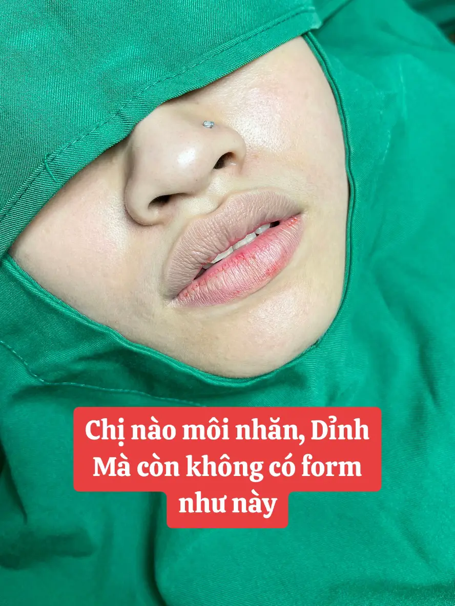 Tạm biệt môi nhăn - tạo form sau 7 Ngày cực đẹp luôn nhé. Chị em mình thích form môi như nào inbox Thuý ạ. Lịch làm việc Sài Gòn 5-6/7 nha.#THUYBEAUTYCENTER #phauthuatthammy 