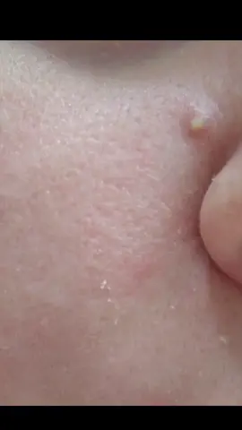 Replying to @wi wi what did you think? #pimples #satisfying #pop #fy #fyp #pimple 