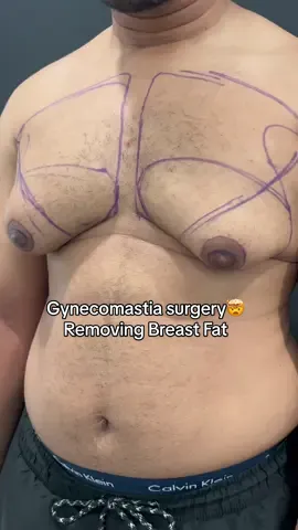 Removing breast fat for men: Gynecomastia surgery🤯🙌🏼 #before #gynecomastia #breastfat #men #patients #transformation #surgery #cosmeticsurgeon #viral #fypage #cosmetic #surgerytiktok #looseskin #plasticsurgeonsoftiktok 