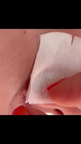 Replying to @Zahli🌴🌊🏝  enjoy the food! #pimples #satisfying #pop #fy #fyp #pimple 