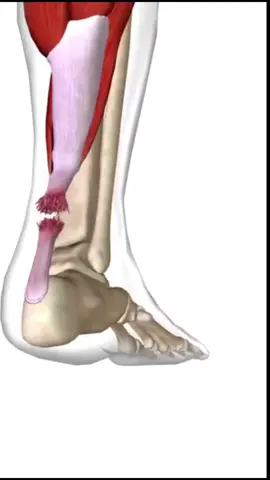 A fisioterapia é essencial na recuperação de uma ruptura do tendão de Aquiles, ajudando a restaurar a função e força do tendão e prevenir futuras lesões. O tratamento fisioterapêutico geralmente segue estas etapas: 1. Fase Aguda (Primeiras Semanas Pós-Lesão):     - Controle da Dor e Edema: Uso de gelo, elevação da perna e compressão.    - Imobilização: Uso de bota ortopédica ou gesso para proteger o tendão enquanto cicatriza.    - Mobilização Suave: Movimentos passivos do tornozelo para evitar rigidez, respeitando as limitações impostas pela imobilização. 2. Fase Subaguda (4-8 Semanas Pós-Lesão):     - Aumento Gradual da Mobilidade: Exercícios de amplitude de movimento, ainda sem carga total no tendão.    - Início da Carga: Introdução gradual de carga parcial no pé afetado, com a ajuda de dispositivos como muletas. 3. Fase de Reabilitação Funcional (8-12 Semanas Pós-Lesão):     - Exercícios de Fortalecimento: Foco nos músculos da panturrilha, tornozelo e pé.    - *lReintegração de Atividades: Progressão para atividades de suporte de peso total e exercícios funcionais específicos. 4. Fase de Retorno ao Esporte ou Atividades Plenas (3-6 Meses Pós-Lesão):     - Treinamento de Resistência e Explosão: Exercícios pliométricos e de resistência avançada para restaurar a força e a potência.    - lAvaliação Funcional: Testes para garantir que o tendão esteja pronto para o retorno às atividades esportivas ou de alta demanda. Durante todo o processo, a fisioterapia personalizada é crucial, adaptando os exercícios e a progressão conforme a resposta do paciente e a gravidade da lesão. A comunicação constante entre o fisioterapeuta e o paciente ajuda a ajustar o plano de tratamento para otimizar a recuperação e minimizar riscos de relesão. #tendaodeaquiles #fisio #fisioterapia #fisioterapeuta #tendaodocalcaneo #fr♿️ 