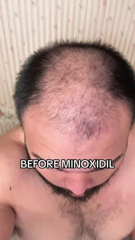 Trust Minoxidil 😎 #minoxidil #hair #hairtransformation #hairloss #hairgrowth #menshealth 