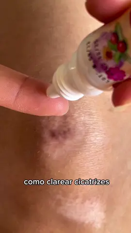 COMO CLAREAR CICATRIZ ESCURA Sabe aquelas cicatrizes escuras que a aparência está bastante feia? Óleo de rosa mosqueta é a solução! Auxilia para a cicatriz ficar mais bonita e uniforme devido aos ácidos graxos e vitaminas A e C na sua composição. Além de ajudar a clarear a pele, também ajuda na organização da síntese de colágeno. Suas propriedades cicatrizantes ajudam a regenerar a pele, estimulando a produção de colágeno e de novas células. ❗️ A recomendação é usar à noite pois o contato com a luz solar causa danos na pele ❗️ Me conta aqui nos comentários se você já sabia desses benefícios desse óleo poderoso 😉 #tiktok #foryou #fyp #fy #pele #pelesaudavel #peleperfeita #cicatriz #cicatrizqueloide #cicatriz #clarearmanchas 