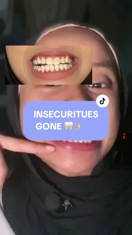 Introducing the ✨SECRET FORMULA✨ especially for whitening your teeth ! 🦷 100% recommended ✅#fyp #zenyum #tiktoksg🇸🇬 #rookiet #creatowin #teethwhitening 