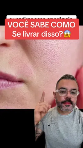 #poros #porosdilatados #porosabertos #cravos #cravoseespinhas #peleoleosa #peleacneica #acidoglicolico #acidohialuronico 