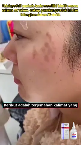 Esensi pemutih dan anti bintik yang baru dikembangkan di Korea Selatan, menghilangkan flek hitam dalam 10 detik, beli 1 gratis 1 Esensi anti bintik 10 detik. Menembus jauh ke dalam lapisan bawah kulit untuk menghilangkan akumulasi melanin di kulit. Harga terendah dalam satu jam terakhir, terbatas 100 buah! Esensi anti noda dan anti bintik yang baru dikembangkan di Korea, promosi diskon merek.