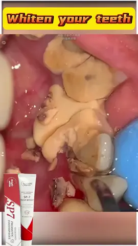 Hilangkan noda kuning pada gigi dengan #pastagigi #sopami #sp7 