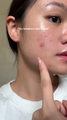 i used acne spot cream too to target only the inflamed acne but this new acne gel moist from skintific iss supperrrv to calm down the breakouts😚👌ib: @Dani 