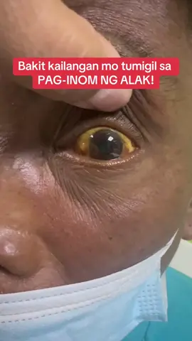 BAWAL UMINOM NG ALAK ! Bakit? #docirma #alcohol #liver irrhosis