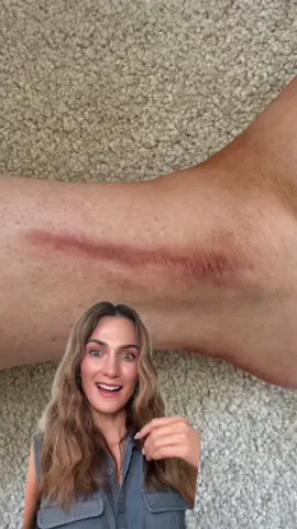 Trimmable. Reusable. Incredible. Nuvadermis Scar Sheets are a powerful solution to both old and new scars. #nuvadermis #scars #skintreatment #transformation 