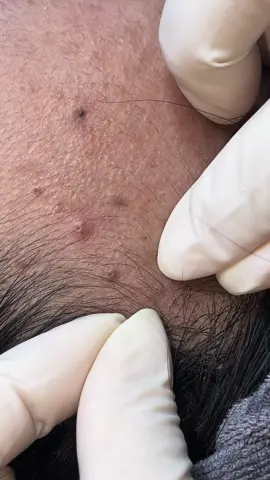 Spa Jun chuyên điều trị da mụn,sinh viên chất lượng phụ huynh 🫶🫶🫶#nanmunchuanykhoacantho #nặn bằng tay#sinhvien #foryou #hetmun #fyp #cầnthơ 