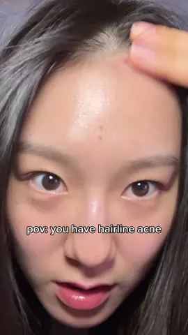 Every time I accidentally touch my hairline acne, it hurts so much 🤣😂 #acneproblems #skincarecommunity #koreanskincare #acne #skincarekorea #related 