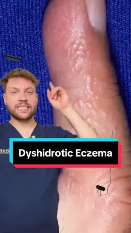 אקזמה דיסהידרוטית היא סוג של אקזמה שמשפיעה בעיקר על הידיים והרגליים, אך יכולה להתרחש גם באזורים אחרים בגוף. המאפיינים העיקריים שלה הם שלפוחיות קטנות ומגדרות שמתפתחות בדרך כלל בקצות האצבעות, בכפות הידיים והרגליים. השלפוחיות מלוות בדרך כלל באדמומיות, דלקת וסדקים בעור. עדיין לא מבינים מה הסיבה המדויקת להתפתחות האקזמה הזו, אך חושדים כי היא קשורה לאלרגיות, ללחץ או לחשיפה לחומרים כגון מתכות וחומרי ניקוי. הטיפול בדרך כלל כולל הימנעות מהטריגרים, שמירה על האזורים לחים, שמוש בקורטיקוסטרואידים מקומיים להקלה על הדלקת, ולפעמים גם בשימוש באנטיהיסטמינים או סטירואידים אוראליים בהתלקחות חמורה.  #רפואה #רפואה_עם_עידן #אקזמה #dyshidroticeczema #ביתחולים #עור #ניתוח 