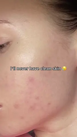 Holy Grail skincare product to fade acne scars and hyperpigmentation 💕 @anua.skincare_us Dark Spot Correcting Serum 🫶 #anua #anuadarkspotserum #kbeauty #koreanskincare #yesstyle #SkinCare101 #glassskin #acneprone #acnescars #darkspots #hyperpigmentation 