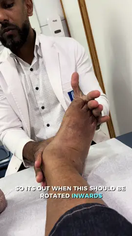 Another extreme case of Diabetic Charcots Foot!🦶🏽                                                       #charcotsfoot #diabetes #diabeticfeet #neuropathy #nervedamage #orthopedics #surgery #amputation #foot #fyp #pain 