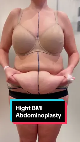 That result 🤩 When it comes to Tummy Tucks, our speciality is creating that contoured, defined, natural look. @Rado Performed Tummy Tuck (Abdominoplasty), repairing her separated muscles, removing the loose skin and excess fat, leaving her with this beautifully contoured result 🙌 She looks incredible! ✨ #tummytuck #tummytuckuk #plasticsurgeon #plasticsurgery #plasticsurgerylondon #cosmeticsurgery #mummymakeover #mummymakeoversurgery #highbmi 