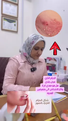 #الدكتوره_زينب_عبدالاله #جلديه #الحزام_الناري #التنومه #البصره 