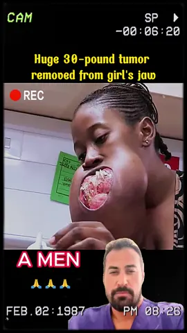 Huge30 - pound tumor removed from girl’s jaw#foryou#tumor#conjoined#conjoinedtwins#surgerry#doctor #doctorsoftiktok #satisfying #viralvideo 
