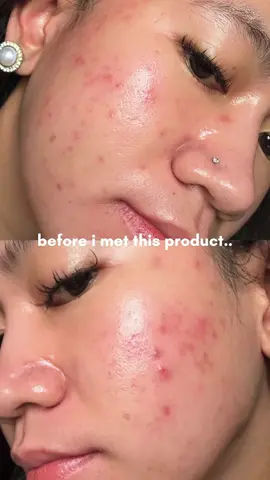 jadi ini dia journey trial & (ga) error ku selama pemakaian lactic acid🥹 rada skeptis sama active ingredients kaya gini tp ternyata sebagus itu.. #skintificlacticacid #skintificexfoliatingserum #skintificreview #acnejourney #acneproneskin 