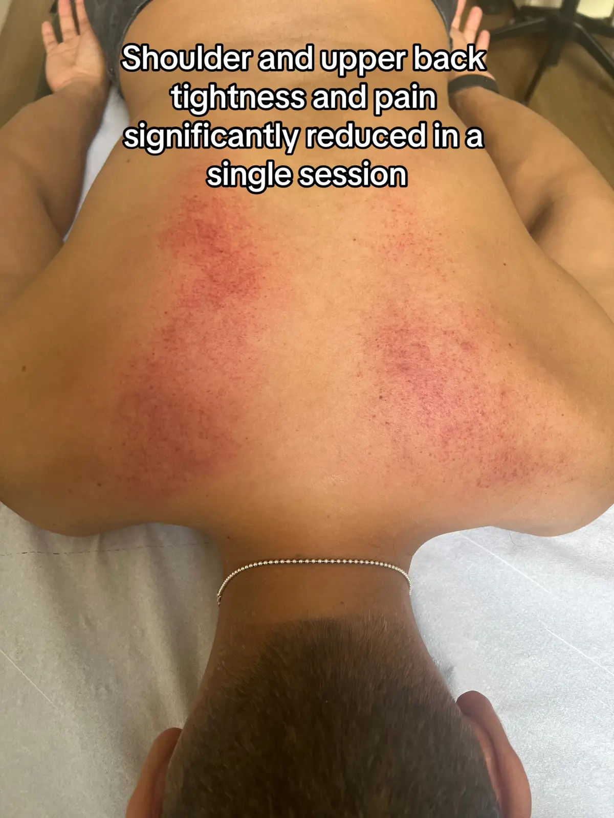 Ditch the pain, say hello to relief! Suffering from shoulder & upper back tightness?   This powerful alternative therapy combo is our secret weapon: Hijama Cupping: Detoxifies & boosts circulation for deeper healing. 🩸 Mix Massage with Graston Technique: Breaks down scar tissue & restores mobility. Together, they'll have you feeling loose & pain-free in no time!     . . #️⃣ #hijama #cuppingtherapy #massagetherapy #grastontechnique #shoulderpain #upperbackpain #painrelief #wellness #naturalhealing #detox #improvedcirculation #scartissuerelease #mobility #hertscupping #increasedrangeofmotion #improvedposture #feelgood #SelfCare #tiktokwellness #cupping #healthylifestyle #musclerecovery #hertfordshire #physicaltherapy #foryou #viral  #fyp