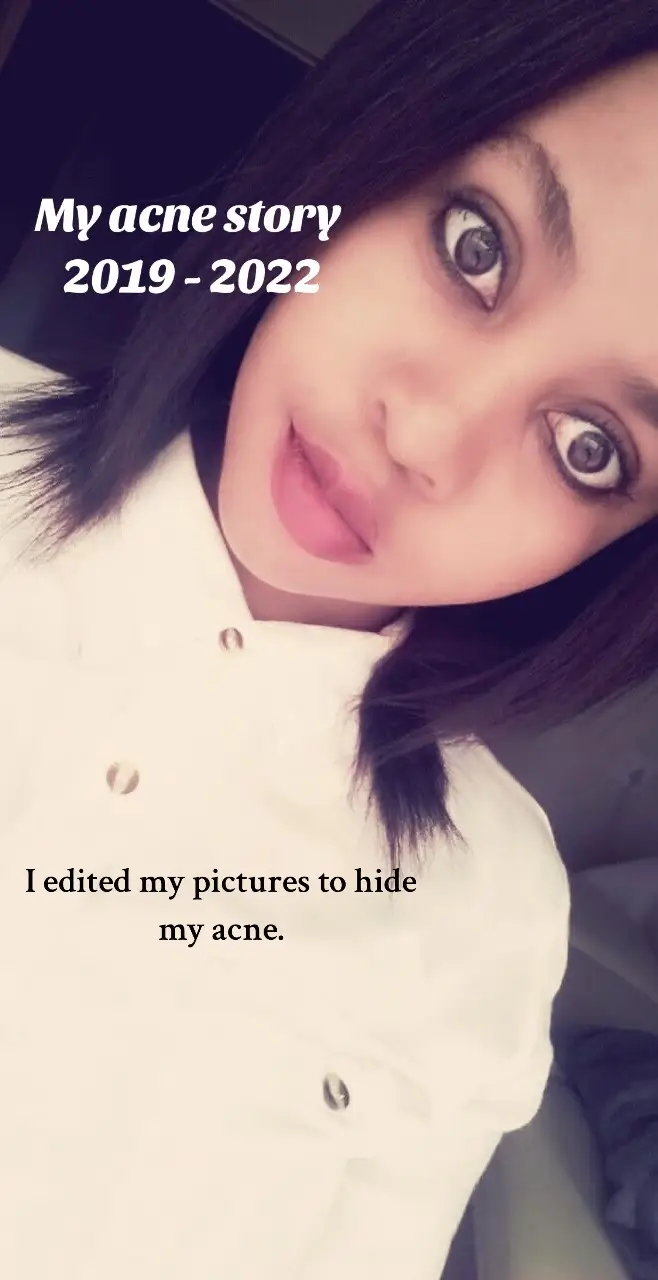 Hey Beautiful ❤️ This is my acne story told in pictures i could take at the time.  #acnepositivity #acnepositive #acneskin #acne #acneawareness #acnestory #hormonalacne #fyp 