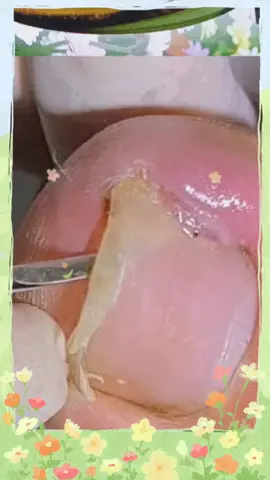 EXTRACTION #pe #unhaencravada #unha #unhasgrandes #extractions #videoviral #viralvideo #viral #satisfying #satisfatório #unhas #asmr #asmrtiktoks #unhainflamada #video #podologia #podologa #podologiacomamor #extraction #satisfyingvideo 