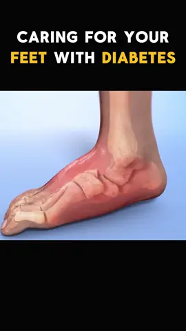 Did You Know How to Take Care of Your Feet If You Have Diabetes?#education #DidYouKnow #treatment #medicaladvice #doctorsoftiktok #process 