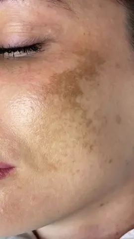 Say Goodbye to Melasma! No M22/Lumecca/BBL needed! Our gentle methods will help to reduce pigmentation and prevent new spots from forming. Procedures: - Light peels (Medipeel, MeLine) - Microcirculation-boosting injections (Meso-Xanthin, Filorga NCTF, Novacutan Ybio) Evening Care: - 1-2 months of AHA serum use (Reviderm, RejudiCare, Don't touch my skin) - Follow up with retinol creams (Sesderma, RejudiCare) Morning Care: - Niacinamide serums (Blith, Anua, Paul's Choice) Remember, daily SPF use is a must! Get ready to say goodbye to melasma and hello to radiant, healthy-looking skin! #MelasmaTreatment #SkinCare #GlowUp #HealthySkin #BeautyTips #SkincareRoutine #PigmentationSolution #RadiantSkin #ConfidenceBoost #SelfCare #Wellness #SkinHealth #MelasmaSolutions #GentleMethods #NaturalSkincare #DailySPF #SunProtection #SkincareLove Contact us to book an appointment:  Consultation and treatment time: Monday to Saturday. Get in touch with us through direct message or phone call to book an appointment. #Laser #AcneScar #SkinSpots #HairTransplant #Beauty #Filler #Rejuvenation #SkinCare #EyebrowTransplant #foryou #fyp #viral #trending #viralvideo #Aesthetics #AntiAging #Botox #ChemicalPeel #CoolSculpting #DermalFillers #FacialRejuvenation #HairRemoval #LaserHairRemoval #LaserSkinTreatments #MedicalSpa #Microdermabrasion #Microneedling #NonSurgical #PlasticSurgery #RadioFrequency #SkinTightening #WrinkleReduction #YouthfulSkin #BeautyClinic #CosmeticDermatology #SkinHealth #AestheticMedicine #BodyContouring #FaceLift #Injectables #LaserResurfacing #SkinRejuvenation #cureme #curememedicalcomplex 