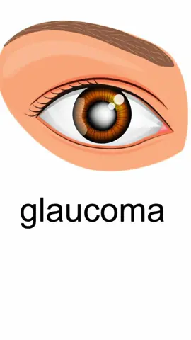 📲Para más información o realizar una consulta por favor contáctanos a este número de WhatsApp +591 77334477 📍 Nos encontramos en Santa Cruz de la Sierra, Bolivia. En el Hospital del Ojo: Av. Irala #330 #glaucoma #laser #oftalmologia #fyp 