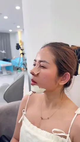 Chiếc mũi + cằm 4 ngày tuổi#muiphongthuy89 #fyp #jlinekorea 