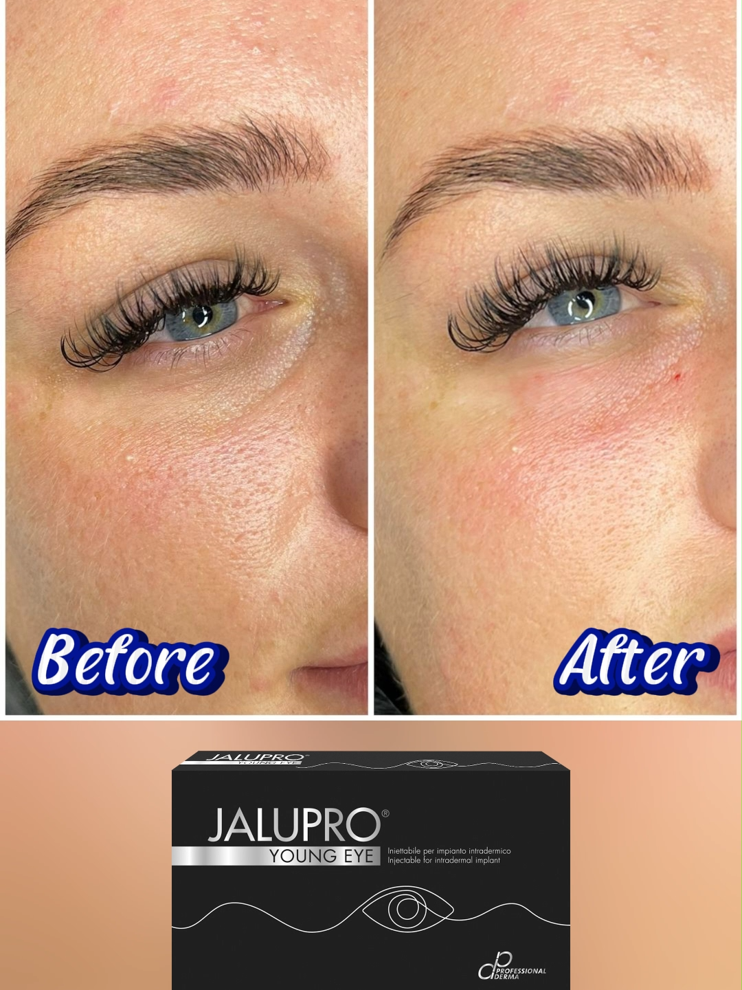⭐ HIỆU QUẢ VƯỢT TRỘI CỦA JALUPRO YOUNG EYE Nhờ các thành phần chất lượng cao cũng công nghệ tiên tiến, Jalupro Young Eye mang lại hiệu quả vượt trội bao gồm: ✨ Giảm thiểu nếp nhăn li ti và nếp nhăn vùng đuôi mắt ✨ Cải thiện quầng thâm và bọng mắt hiệu quả ✨ Làm sáng và đều màu da quanh mắt ✨ Tăng cường độ đàn hồi và săn chắc cho da ✨ Mang lại ánh nhìn trẻ trung, rạng rỡ và đầy sức sống cho đôi mắt #jalupro #jaluprovietnam #jaluprovn #tinhchattrehoa #trehoacangbong #trehoa #trehoada #jaluproyoungeye #nangco #trehoamat #kythuattiemvidiem #kythuatdocquyen #monhan #xoathammat