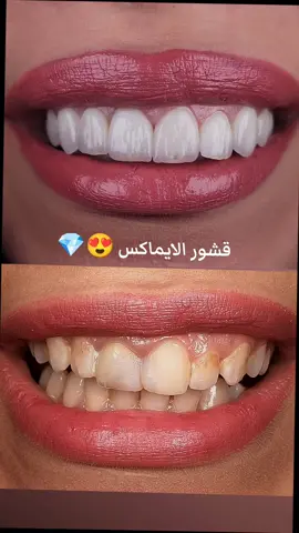 تغير الابتسامه باستخدام قشور الايماكس 😍 #ابتسامة_هوليود #اسنان_جميلة #تغليف_أسنان_الزاركون #زراعة_الاسنان #طبيبه_اسنان #اكسبلور_explore_فولو 